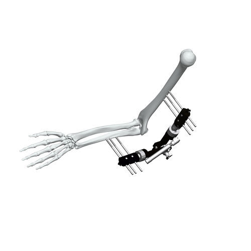 Fixateur externe / für Ellbogen - FE5M-D040 - Chongqing FWS Medical Device - rohrförmig / für Erwachsene