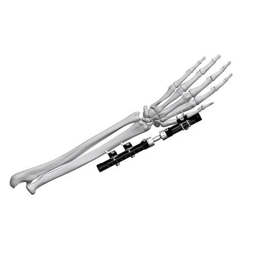 Fixateur externe / für Handgelenk - FE5M-D030  - Chongqing FWS Medical Device - rohrförmig / für Erwachsene