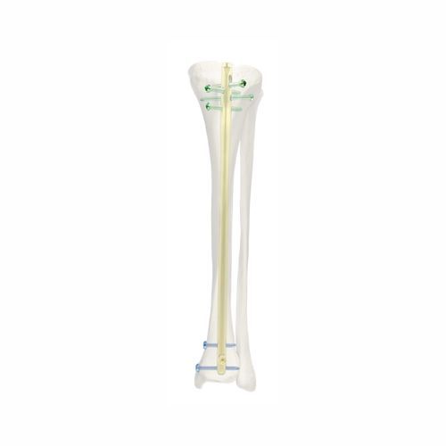 Marknagel / für Schienbein - SJGK - Chongqing FWS Medical Device