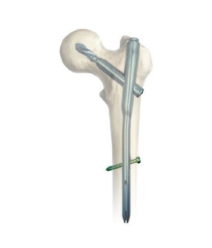 Marknagel für Oberschenkelknochen - SGM - Chongqing FWS Medical Device - mit proximaler Fixierung / Titan