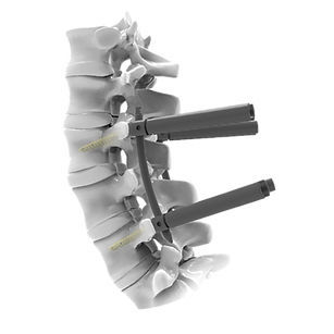 Stabilisierungssystem für Osteosynthese / LWS - CTS 5.5 MIS - Mediox - dorsaler Zugang / für Erwachsene