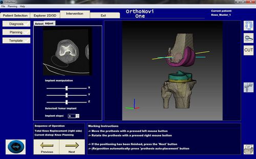 Planungssoftware - OrthoNovi - SurgiNovi - Präoperative Planung / Erfassung / medizinisch