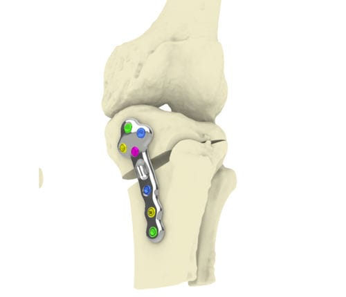 Osteotomieplatte für Tibia - TOKA - Orthoscape - mit Verriegelung / Metall