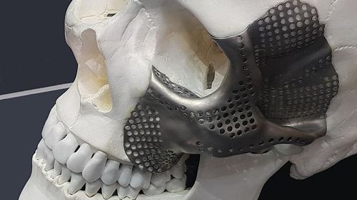 Patientenspezifisches Orbitalimplantat - OrthoCMF - Orthoscape - nicht resorbierbar