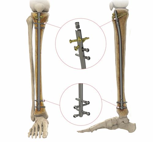 Marknagel / für Schienbein - AS.ATN.401 - Ases Orthopedics - mit proximaler Fixierung / mit distaler Fixierung / Titan