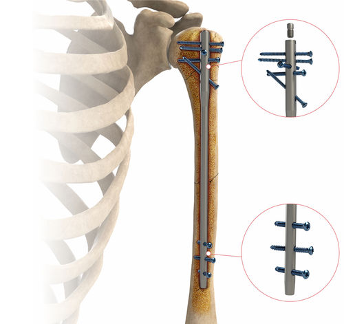 Marknagel / Humerus - AS.HUM.402 - Ases Orthopedics - mit diaphysärer Fixierung / mit proximaler Fixierung / rechts