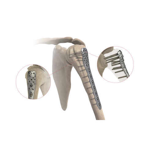 Kompressionsplatte für Humerus - AS.SH.026 - Ases Orthopedics - proximal / seitlich / mit Verriegelung