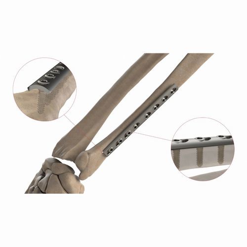 Kompressionsplatte für Radius - AS.ST.064 - Ases Orthopedics - für Ulna / medial / ohne Verriegelung