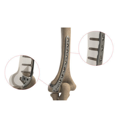 Kompressionsplatte für Humerus - AS.E.022 - Ases Orthopedics - distal / dorsolateral / mit Verriegelung