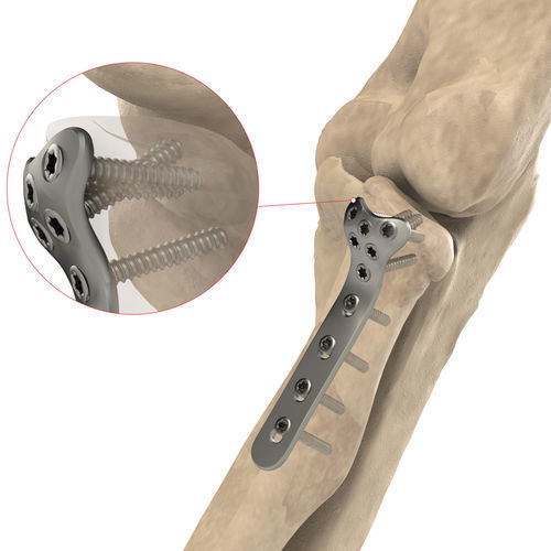Kompressionsplatte für Radiuskopf - AS.E.019 - Ases Orthopedics - proximal / mit Verriegelung / Titan