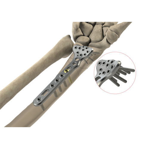 Kompressionsplatte für Radius - AS.W.011 - Ases Orthopedics - distal / mit Verriegelung / ohne Verriegelung