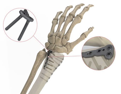 Kompressionsplatte für Radius - AS.W.014 - Ases Orthopedics - distal / dorsal / mit Verriegelung