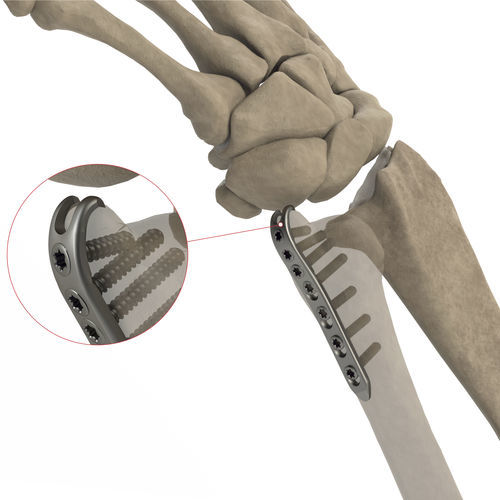 Kompressionsplatte für Ulna - AS.W.016 - Ases Orthopedics - distal / mit Verriegelung / ohne Verriegelung