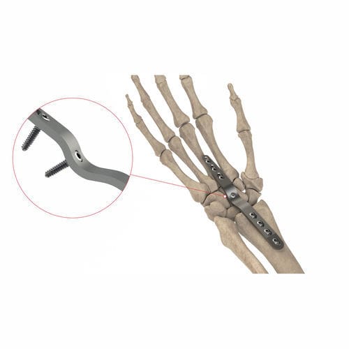 Arthrodeseplatte für Handgelenk - AS.W.074 - Ases Orthopedics - dorsal / mit Verriegelung / ohne Verriegelung