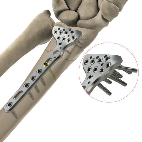 Kompressionsplatte für Radius - DR Volar - Ases Orthopedics - distal / mit Verriegelung
