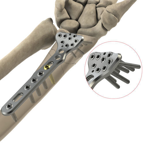Kompressionsplatte für Radius - DR Volar II - Ases Orthopedics - distal / palmar / mit Verriegelung