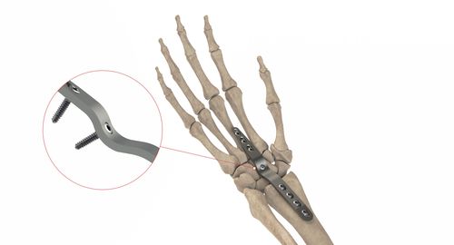 Kompressionsplatte für Handwurzelknochen - HC Artrodesis LP - Ases Orthopedics - mit Verriegelung