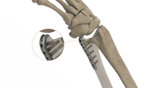 Kompressionsplatte für Ulna - Styloid LP - Ases Orthopedics - mit Verriegelung