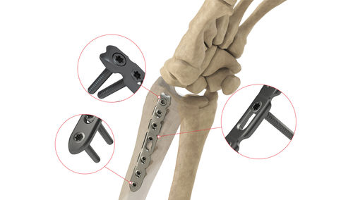 Kompressionsplatte für Radius - DR Lateral LP - Ases Orthopedics - distal / seitlich / mit Verriegelung