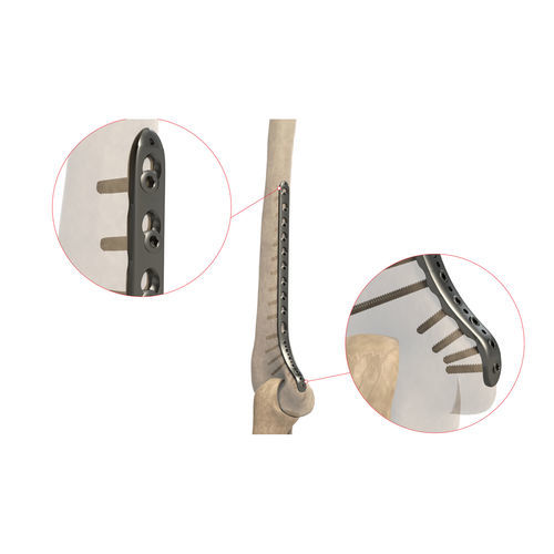 Kompressionsplatte für Humerus - Ases Orthopedics - distal / medial / mit Verriegelung