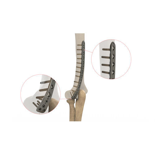 Kompressionsplatte für Humerus - Ases Orthopedics - distal / dorsolateral / mit Verriegelung