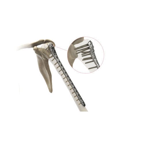 Kompressionsplatte für Humerus - Ases Orthopedics - proximal / mit Verriegelung