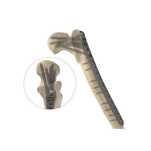 Kompressionsplatte für Oberschenkelknochen - Ases Orthopedics - proximal / mit Verriegelung