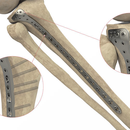 Kompressionsplatte für Tibia - Ases Orthopedics - proximal / seitlich / mit Verriegelung