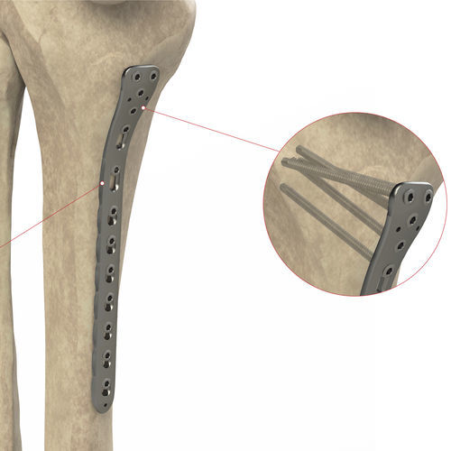 Kompressionsplatte für Tibia - Ases Orthopedics - proximal / medial