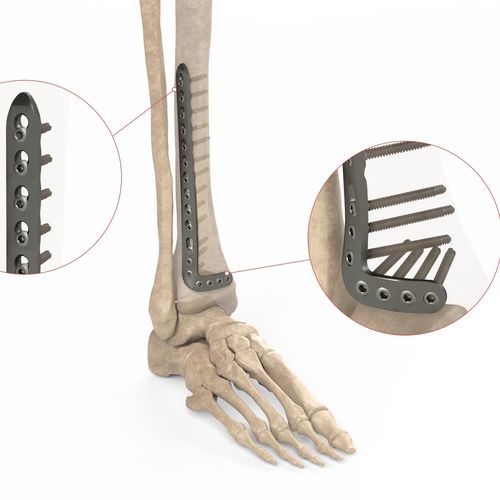 Kompressionsplatte für Tibia - Ases Orthopedics - distal / anterolateral / mit Verriegelung