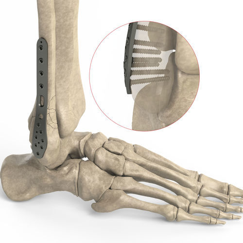 Kompressionsplatte für Fibula - Ases Orthopedics - distal / seitlich / mit Verriegelung
