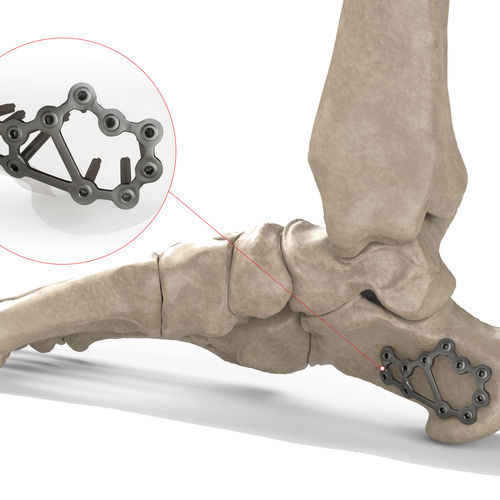 Kompressionsplatte für Calcaneum - Ases Orthopedics - mit Verriegelung