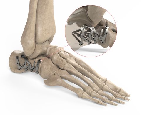 Kompressionsplatte für Calcaneum - Ases Orthopedics