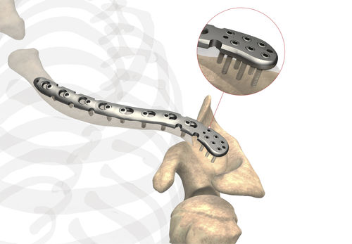 Kompressionsplatte für Schlüsselbein - Ases Orthopedics - distal / mit Verriegelung