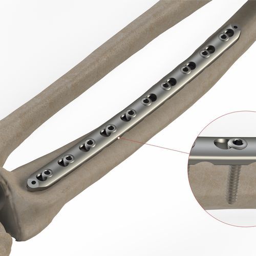 Kompressionsplatte für Radius - 1T12 series - Ases Orthopedics - distal / mit Verriegelung