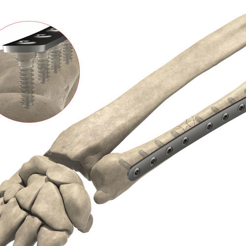 Kompressionsplatte für Ulna - 1T12-06404 - Ases Orthopedics - distal / mit Verriegelung