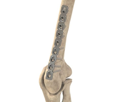 Kompressionsplatte für Humerus - 1T12-04104 - Ases Orthopedics - distal / seitlich / mit Verriegelung