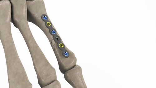 Kompressionsplatte für Mittelhandknochen - 1T112-10092006 - Ases Orthopedics - mit Verriegelung
