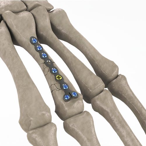 Kompressionsplatte für Mittelhandknochen - 1T112-100102023 - Ases Orthopedics - mit Verriegelung