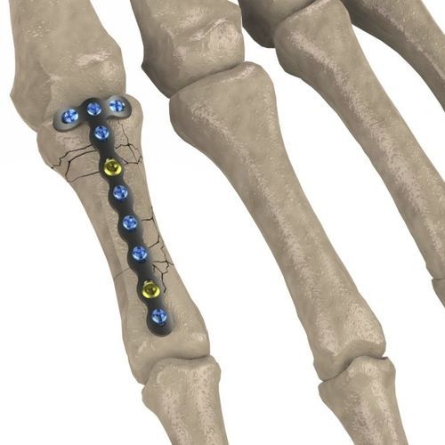 Kompressionsplatte für Fingergrundgelenk - 1T112-100122033 - Ases Orthopedics - mit Verriegelung