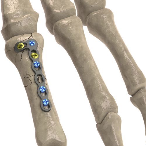 Kompressionsplatte für Fingerglied - 1T112-100242705L - Ases Orthopedics - mit Verriegelung