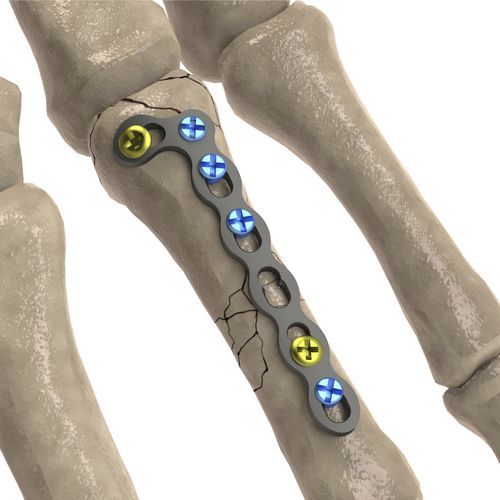 Kompressionsplatte für Fingerglied - LCP Oblique L - Ases Orthopedics - mit Verriegelung