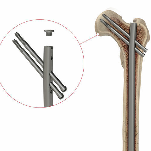 Marknagel für Oberschenkelknochen - 4T1-4001050 - Ases Orthopedics - mit proximaler Fixierung