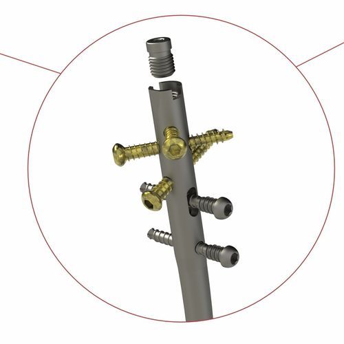 Marknagel / für Schienbein - 4T1-4011000 - Ases Orthopedics