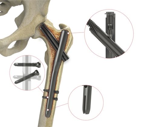 Marknagel für Oberschenkelknochen - 4T1-40310170 - Ases Orthopedics - mit proximaler Fixierung