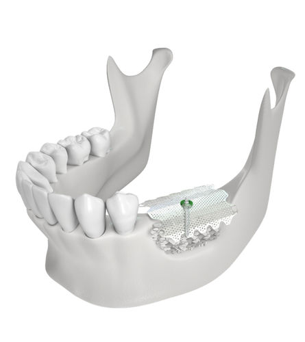 Zahnmedizinisches Material / Titan - CTi-mem - Neobiotech - zur Dentalrestaurierung