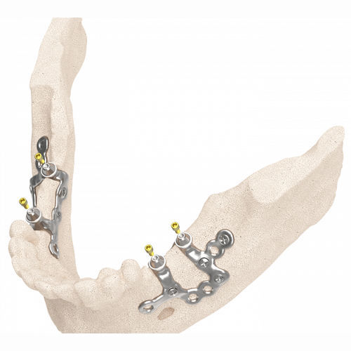 Chirurgische Schablone / Dental - IUXTA 3D - Biotec - BTK