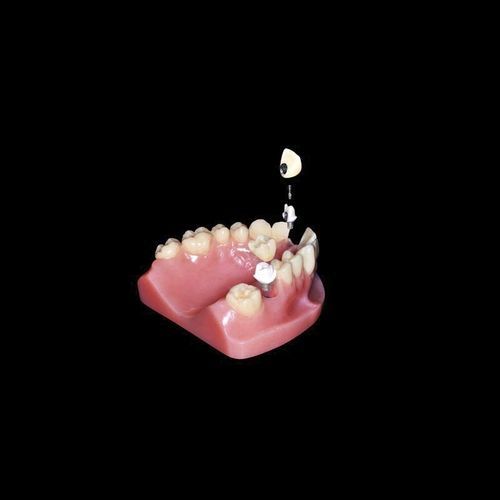 Implantat-Abutment / Titan - Shenzhen Alcadent Co.Ltd Alcadent Dental Laboratory - Zirkonoxid / PEEK / mit Innenverbindung