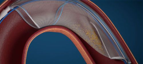 Embolie-Filtersystem / Aorten - FLOWer - Aorticlab