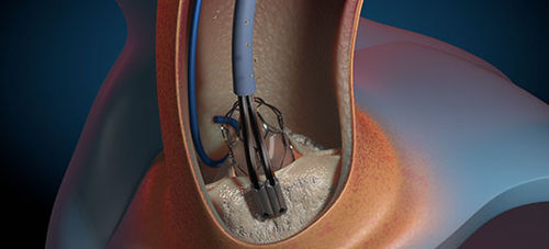 Atherektomiekatheter - GEMINI  - Aorticlab - Aorta